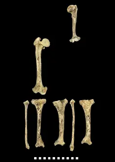 Achondroplastic: Bones of Achondroplastic Dwarf