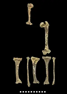 Achondroplastic: Bones of Achondroplastic Dwarf