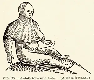 Membranes: BORN WITH A CAUL