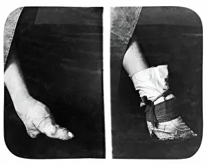 Deformed: Bound foot, China