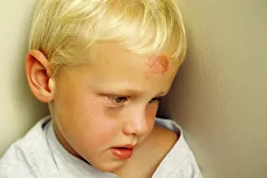 Bruised: BOY WITH BRUISED FOREHEAD