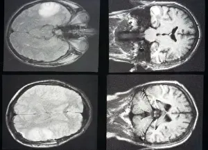 Cancerous: Brain Metastases from Melanoma, MRI
