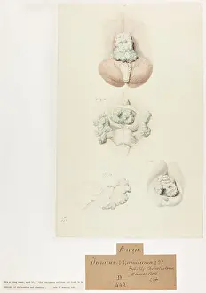 Ucl Library Services Digital Collections: Brain Tumour: Epithelioma