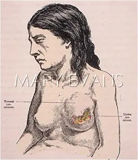 Tumour: BREAST CANCER