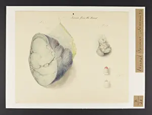 Tumour: Breast: Tumour