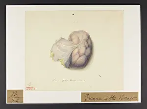 Ucl Library Services Digital Collections: Breast: Tumour
