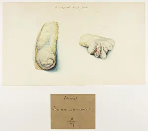 Ucl Library Services Digital Collections: Breast: Tumour