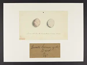 Ucl Library Services Digital Collections: Breast: Tumour