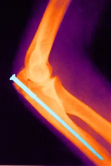 Strengthen: Broken Arm with Metal Pin, X-Ray