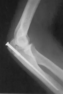 Procedure: Broken Arm with Metal Pin, X-Ray