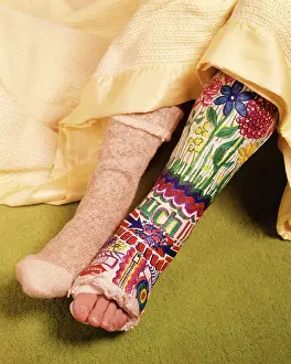 Fibula: Broken Leg in Colorful Plaster Cast Decorated