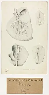 Dilatation: Bronchi: Dilatation and Obliteration