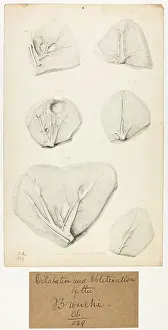 Dilatation: Bronchi: Dilatation and Obliteration