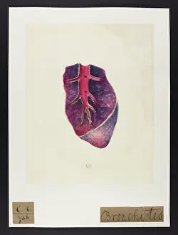 Sticky: Bronchitis