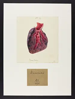 1837: Bronchitis