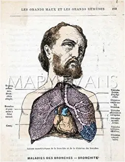 Bronchitis: A BRONCHITIS PATIENT