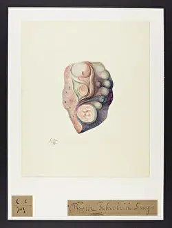 Brown Tubercles in Lungs