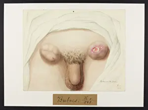 Hospice: Buboes in Groin