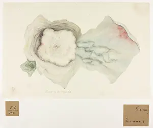 1827: Caecum: Tumour in the Caput Coli