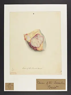 Ucl Library Services Digital Collections: Cancer of the Breast