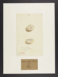 Ucl Library Services Digital Collections: Cancer of the Breast