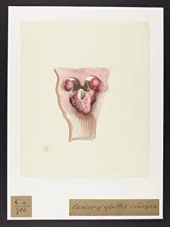 Recto: Cancer of the Glottis and Larynx