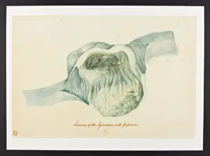 Cancer: Cancer of the Jejunum with Perforation