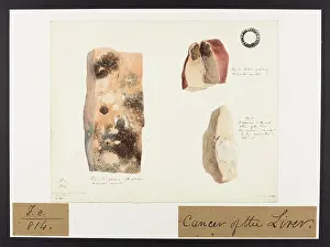Liver: Cancer of the Liver