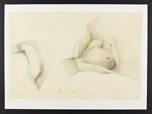 Stomach: Cancer of Stomach