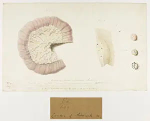 Stomach: Cancer of Stomach, tubercular peritonitis