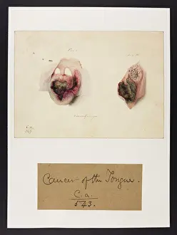 1831: Cancer of the Tongue