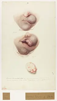 Removal: Cancerous Tumour of Cheek