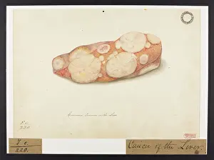 Tumours: Cancerous Tumours in the Liver
