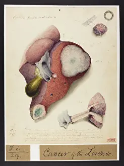 Liver: Cancerous Tumours in the Liver