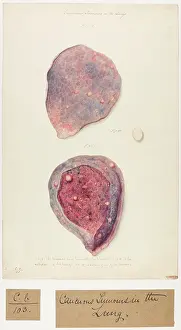 Lung: Cancerous Tumours in the Lung