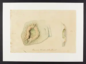 Stomach: Cancerous Ulceration of Stomach