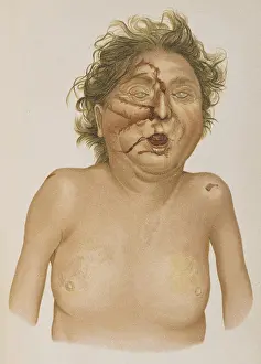 Oxide: Carbon monoxide Poisoning, Agonal Injuries, 1898