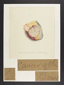 Ucl Library Services Digital Collections: Carcinoma of Breast