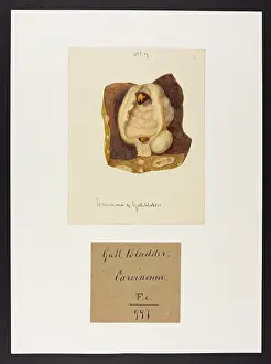 1834: Carcinoma of Gall Bladder