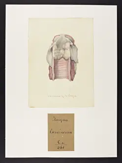 Ucl Library Services Digital Collections: Carcinoma of the Larynx