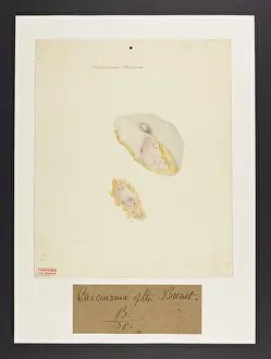 Ucl Library Services Digital Collections: Carcinoma Mamma