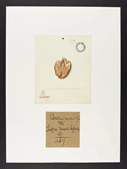 Capsule: Carcinoma of the Suprarenal Capsule