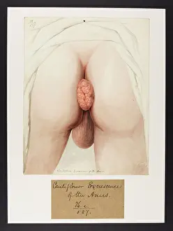 Cauliflower: Cauliflower Excrescence of Anus