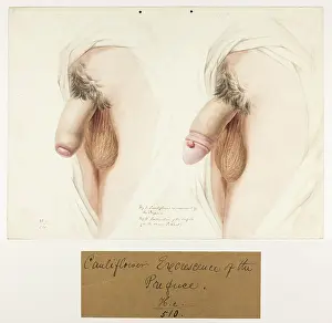 Contraction: Cauliflower Excrescence of Prepuce, Contraction of Orifice