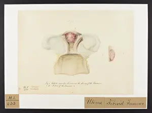 Tumour: Cellulo-Vascular Tumour in Cavity of Uterus