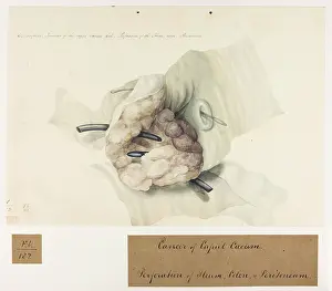 Colon: Cerbriform Tumour: Caput Caecum Coli
