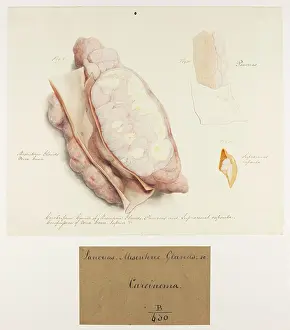 1831: Cerebriform Cancer of the Mesenteric Glands