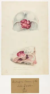 Tumour: Cerebriform Tumour