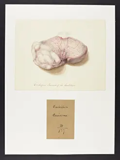 1826: Cerebriform Tumour of the Cerebellum