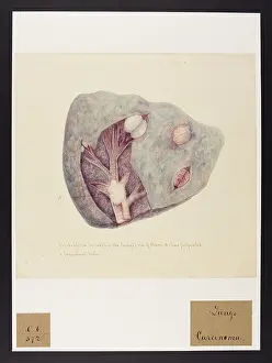 Lungs: Cerebriform Tumours in the Lungs